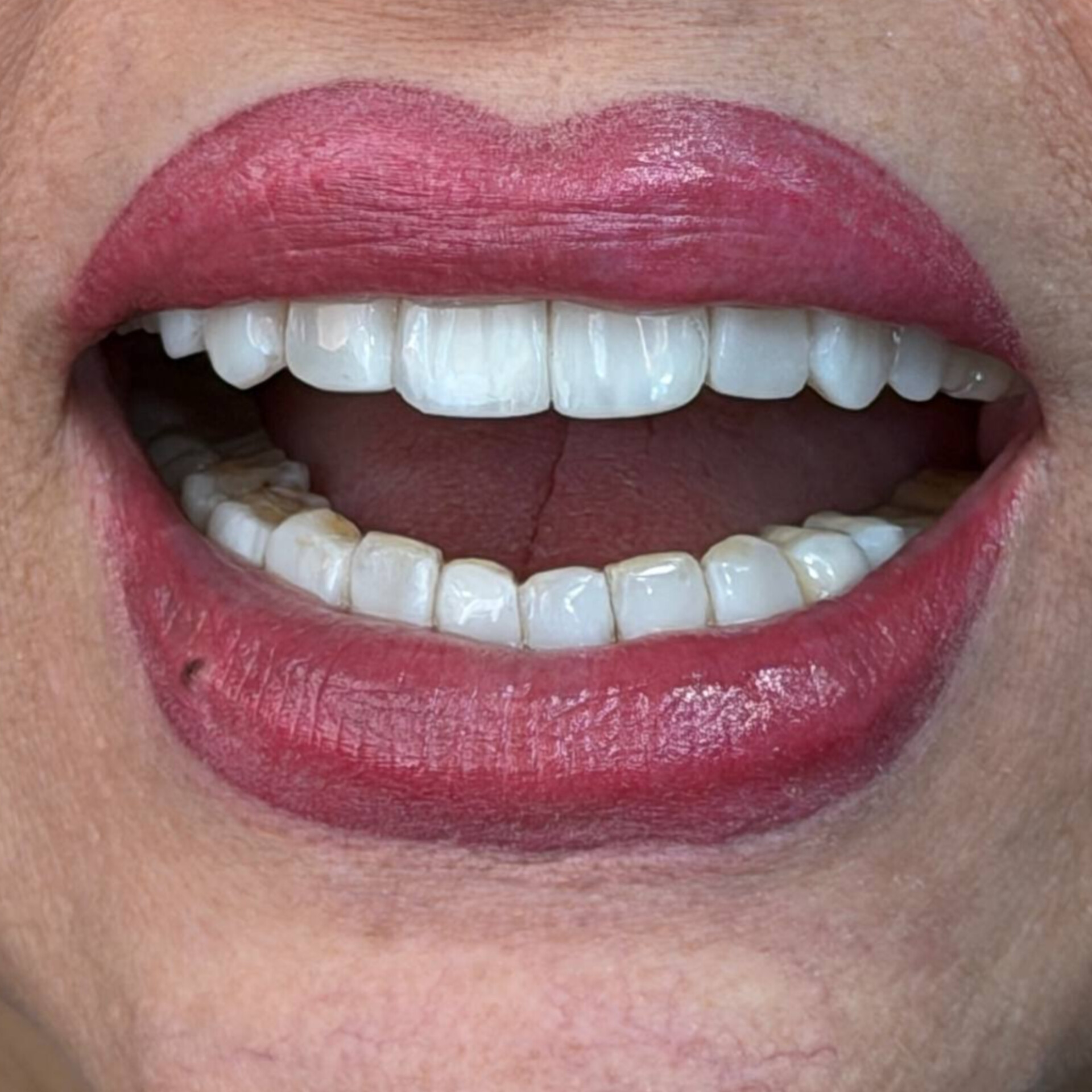 نمونه کار دندانپزشکی دکتر میترا آداودی دندانپزشک اصفهان سه راه سیمین