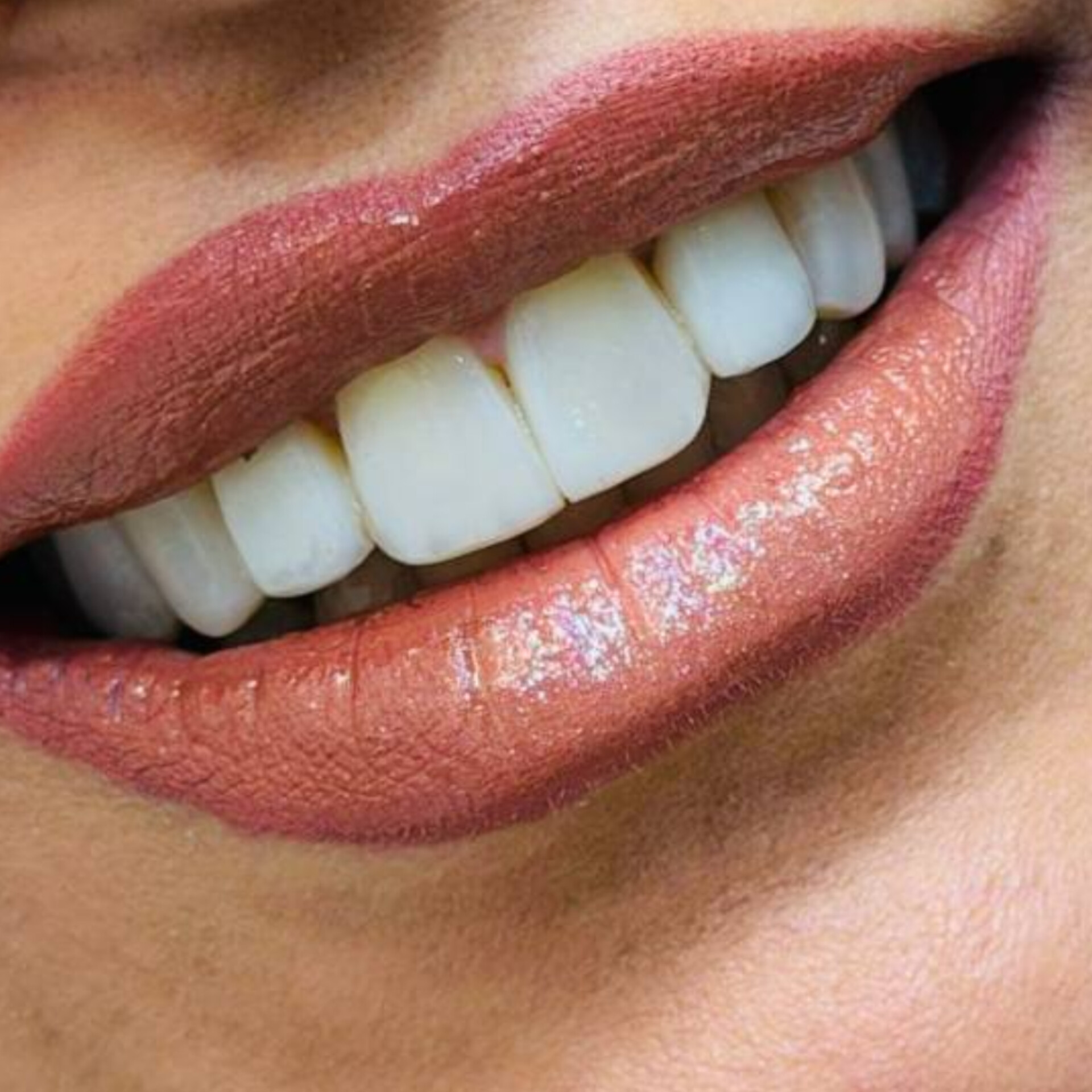 نمونه کار دندانپزشکی دکتر میترا آداودی دندانپزشک اصفهان سه راه سیمین
