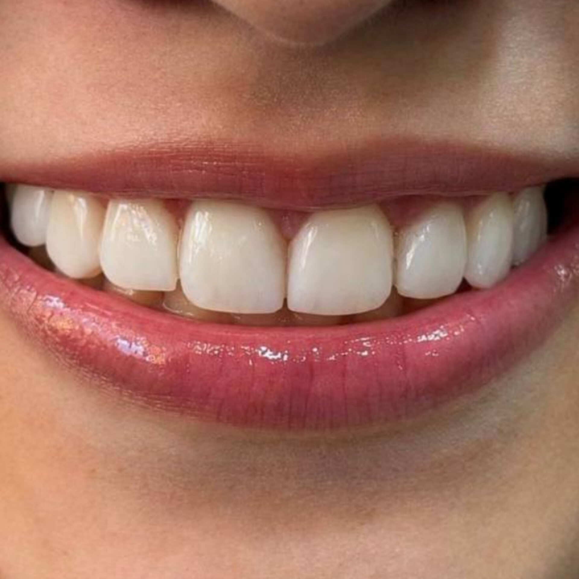 نمونه کار دندانپزشکی دکتر میترا آداودی دندانپزشک اصفهان سه راه سیمین